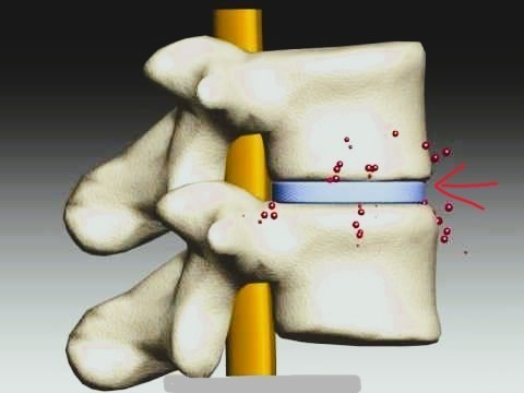 spinal decompression, disc degeneration, lumbar disc pain